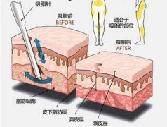 吸脂瘦腿手术怎么样(瘦大腿吸脂术)